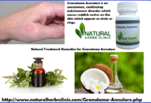 Granuloma-Annulare-in-Adults-Granuloma-Annulare-Natural-Treatment-Natural-Treatment-for-Granuloma-Annulare