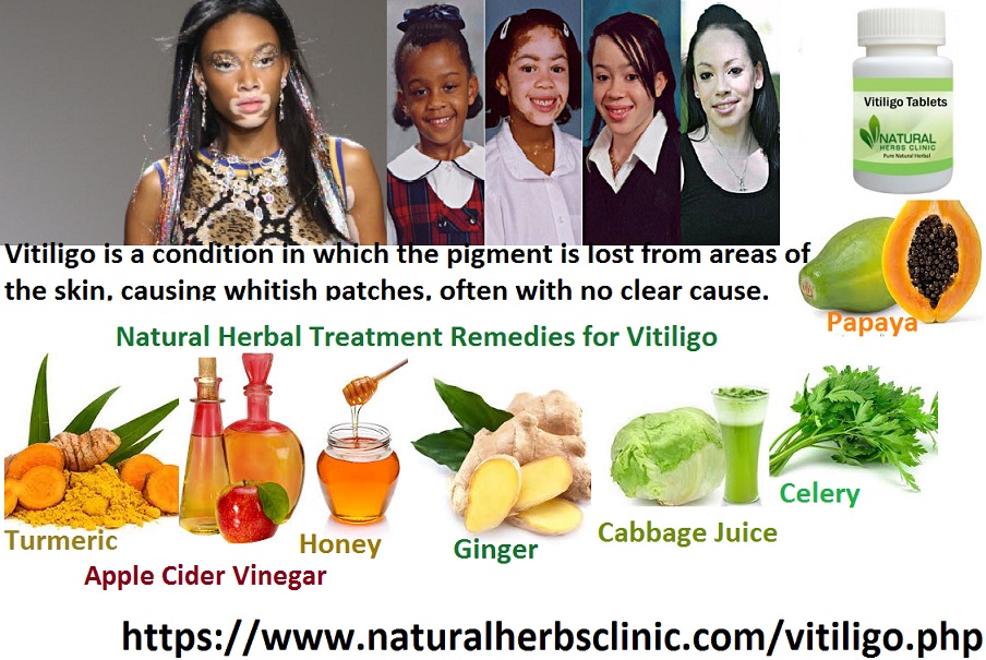 8 Natural Herbal Treatment Remedies For Vitiligo Natural Herbs Clinic Blog 0280