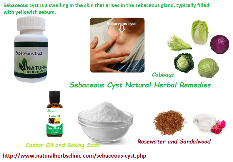 Herbal Remedies For Sebaceous Cyst | Causes, Symptoms, Treatment ...