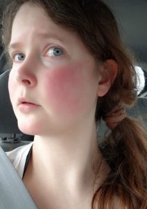 polycythemia flushing rosacea dealing burning lessen