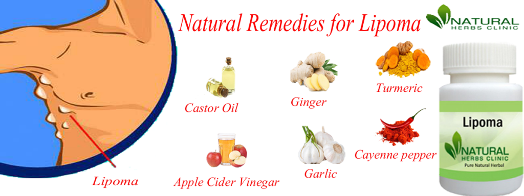 How To Treat Lipoma Completely With Natural Remedies