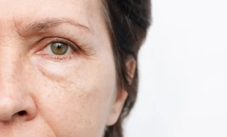 How to get rid of eye bags, according to dermatologists