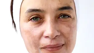 Melasma 101 From A Skin Health Expert