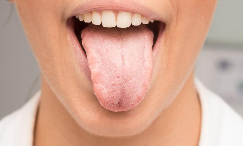 Lichen Planus Mouth Treatment Innovative Solutions for Quick Relief