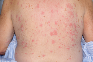 How to Treat Pemphigoid Bullous Naturally