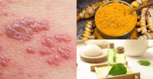 lichen-planus-natural-alternative-treatment