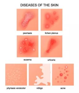 lichen-planus-natural-alternative-treatment