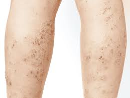 lichen-planus-natural-alternative-treatment