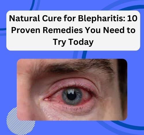 Natural Cure for Blepharitis