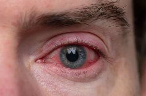 Natural Cure for Blepharitis